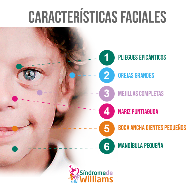 El Síndrome de Williams: Características, Causas y Día Mundial ...